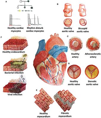 Toward the Effective Bioengineering of a Pathological Tissue for Cardiovascular Disease Modeling: Old Strategies and New Frontiers for Prevention, Diagnosis, and Therapy